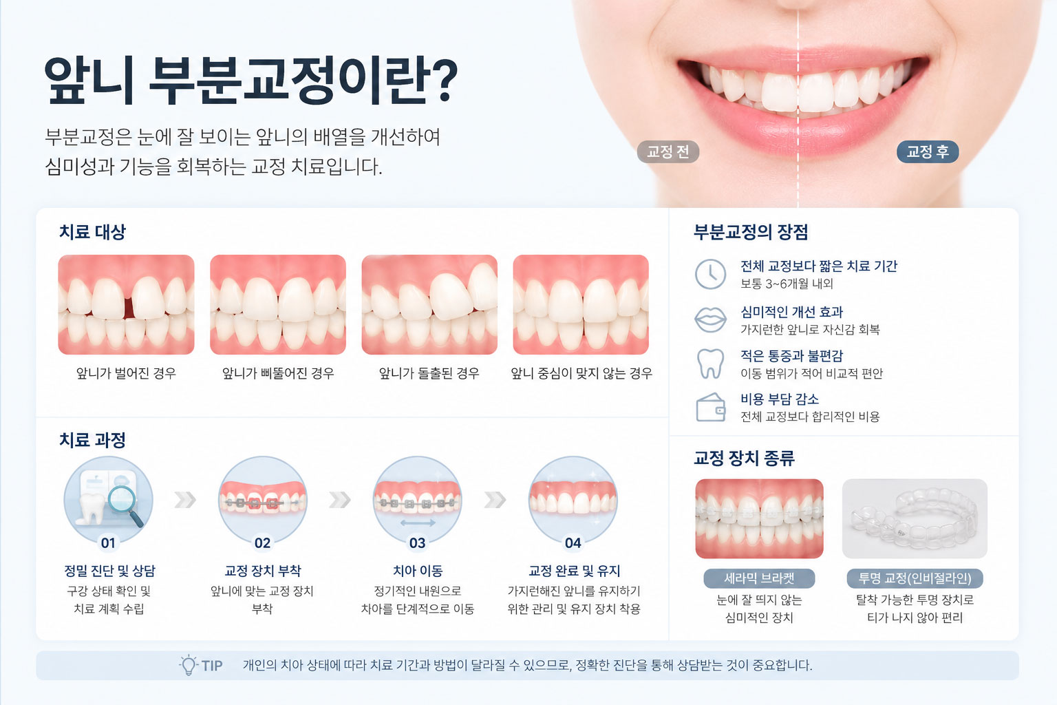 안양 부분교정 치료 스마일민 치과교정과