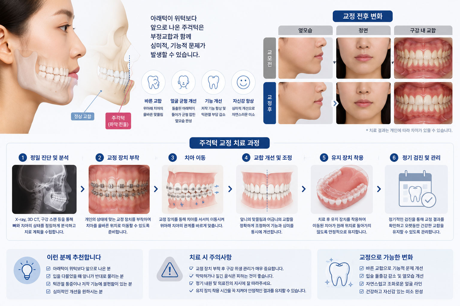 안양 주걱턱 교정 하악전돌증 설명 스마일민 치과교정과