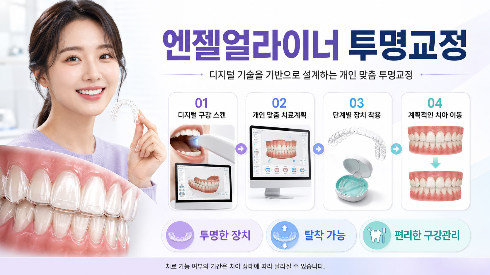 안양 엔젤얼라이너 투명교정 특징 스마일민 치과교정과