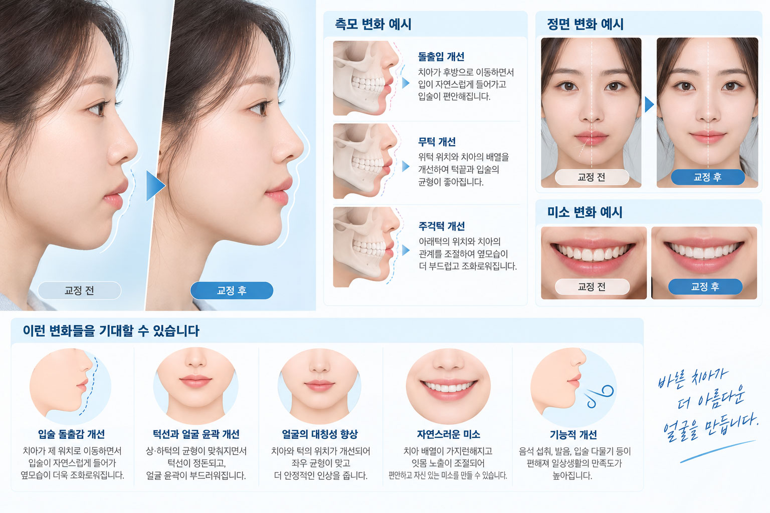 안양 교정 안모변화 옆모습 예측 스마일민 치과교정과
