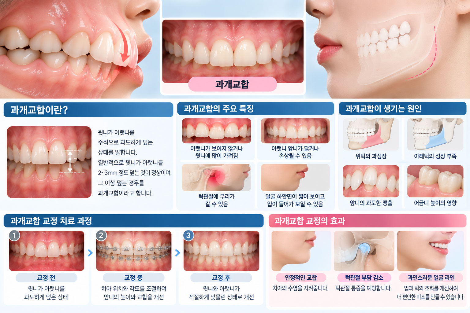 안양 과개교합 교정 깊은 교합 설명 스마일민 치과교정과