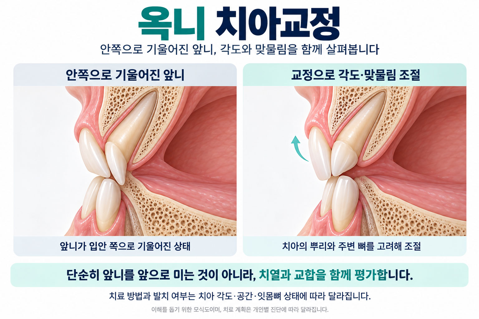 안양 옥니 교정 안으로 기울어진 앞니 스마일민 치과교정과